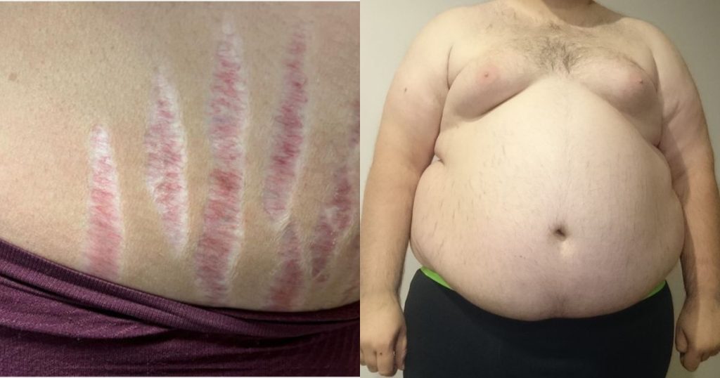 Kušingo sindromo požymiai, violetinės strijos ir riebalai ties liemeniu